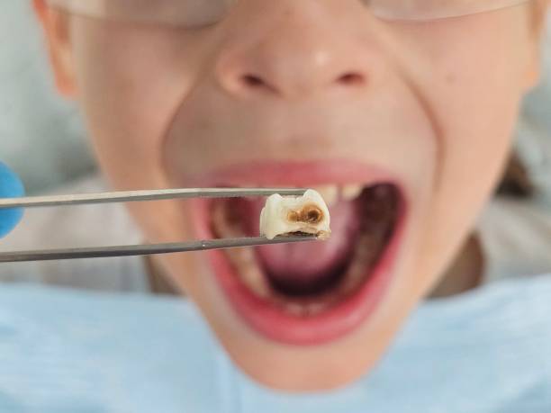 Best Urgent Tooth Repair  in Emerald Lake Hills, CA