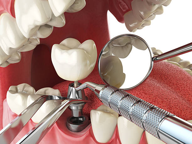 Best Broken Tooth Emergency  in Emerald Lake Hills, CA